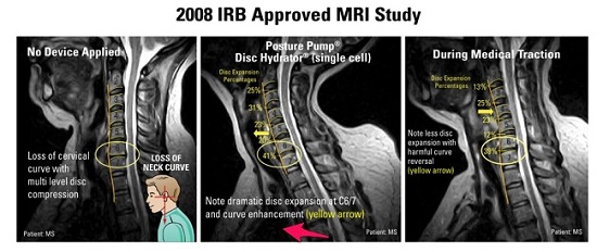 posture pump studies and research