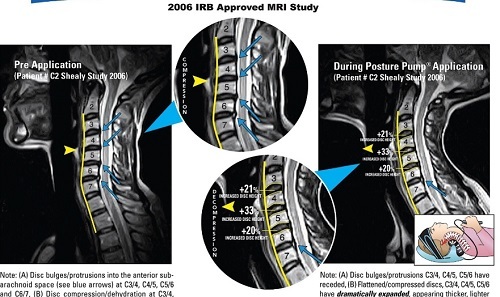 posture pump before after study